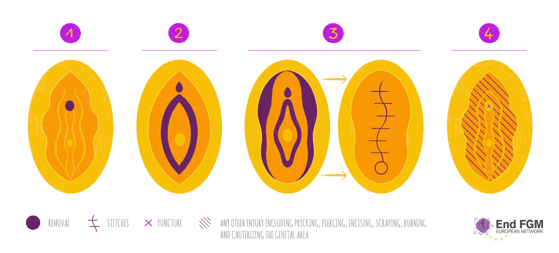 What is FGM? | End FGM